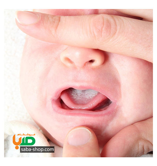 درمان برفک روی زبان نوزاد