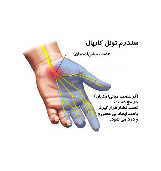 تنگی کانال عصب مچ دست یا سندروم تونل کارپال (C.S.T)