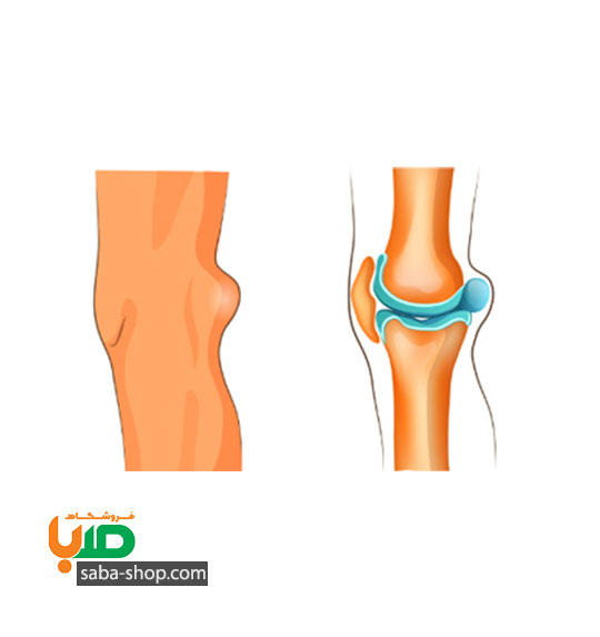 درمان کیست در پشت زانو یا در مچ پا