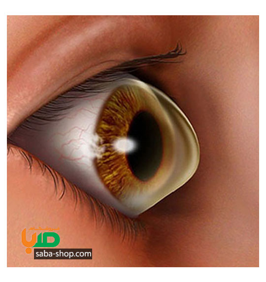 درمان ناهمواری قرنیه چشم