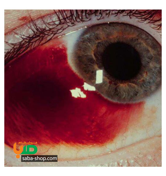 درمان خونریزی چشم